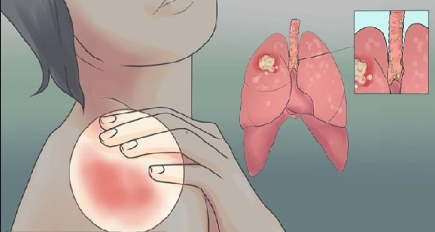 как да разпознаете ранните признаци за рак на белия дроб