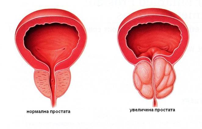 как се лекува простата