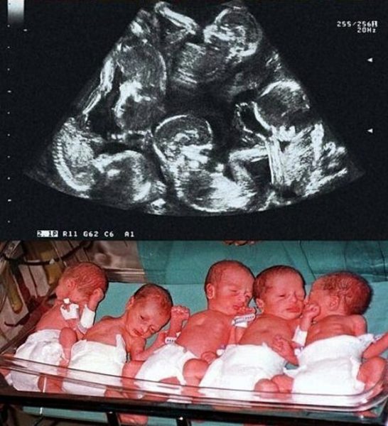 Александра мислеше, че чака близнаци, но резултатите от видеозона я шокираха толкова много, че започна да плаче (СНИМКИ)
