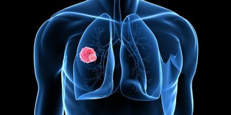 Домашен тест показва имаме ли рак на белия дроб