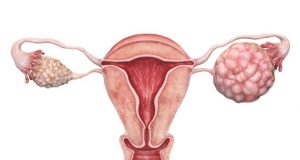 Ракът на яйчниците убива безшумно! Това са 4 ранни симптома които всяка жена трябва да знае! (+ РЕЦЕПТА)