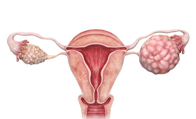 Ракът на яйчниците убива безшумно! Това са 4 ранни симптома които всяка жена трябва да знае! (+ РЕЦЕПТА)