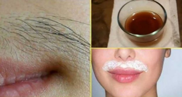 Няколко капки йод и край с хайдушкия мустак на женското лице! Никога не е било толкова лесно и безболезнено: