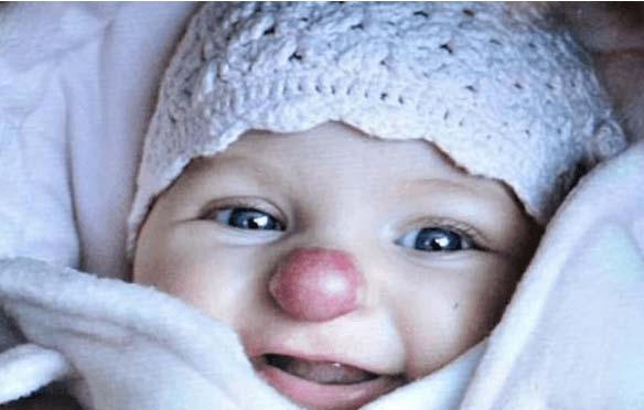 Преди 9 години това чаровно момиче се роди с "клоунски нос". Как живее и как изглежда днес?