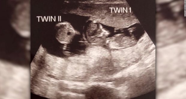 Медицинско чудо! Жена забременя докато беше бременна - ето резултата (СНИМКИ)