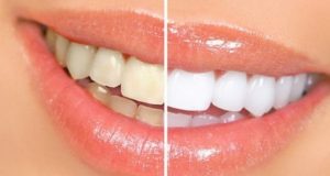 Как да избелим зъбите с няколко нюанса без да даваме повече от левче – 8 действащи домашни метода