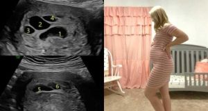 Бременна жена отива на ултразвук вижда 6 черни кръга около бебето си на екрана