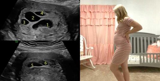Бременна жена отива на ултразвук вижда 6 черни кръга около бебето си на екрана