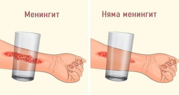 8 симптома на менингит, които всеки родител трябва да знае: