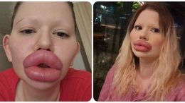 БГ Барби иска още хиалурон докторите не дават