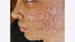 Опасна процедура за лице съсипа млада жена прати я в болница с втора степен изгаряне