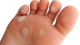 Безболезнен метод за премахване на кокоши трън за 4 дни: Баба ми ме научи на това прилагам го от години!