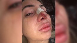 Жена остана без нос след операция при лекар с фалшива диплома