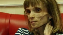 Кристина която тежи само 17 кг: „Моето послание към всички които са на диета е - Първо губите косата си после зъбите си а после...