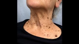 Притесняват ли ви папиломи и брадавици? Ето как можете да се отървете от тях ЗАВИНАГИ - лесно и безопасно!